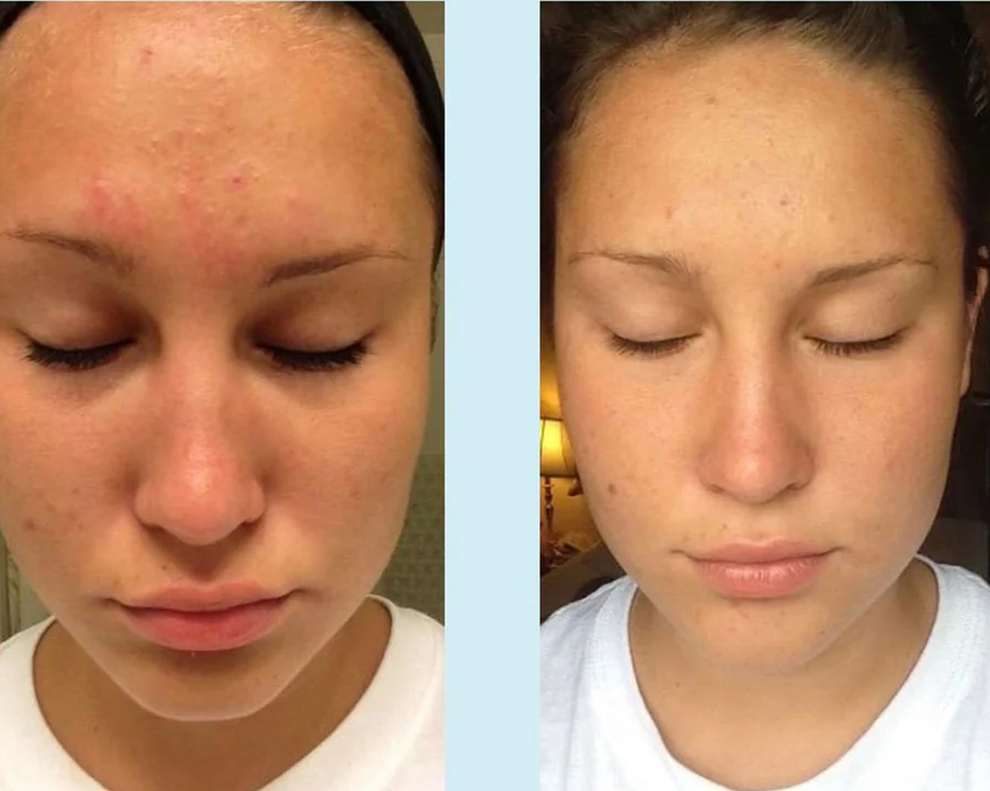 Glycolic Gel Peel