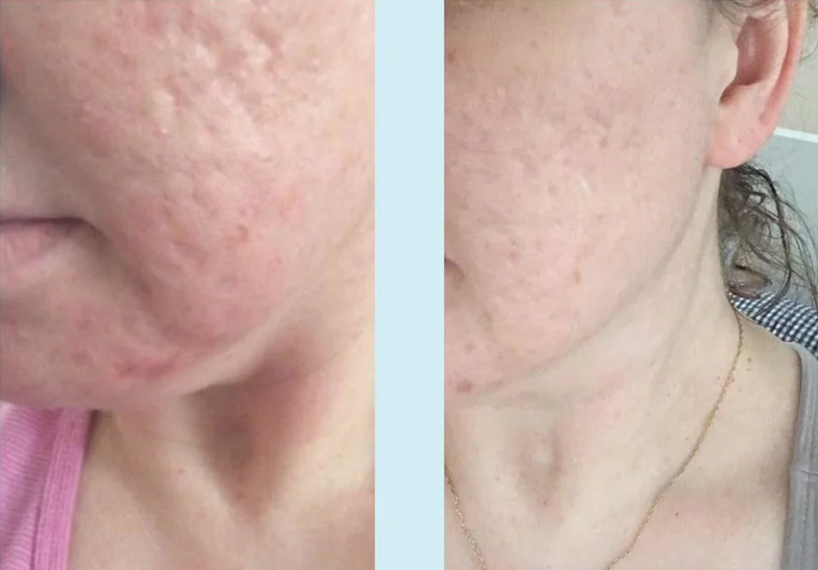 Glycolic Gel Peel