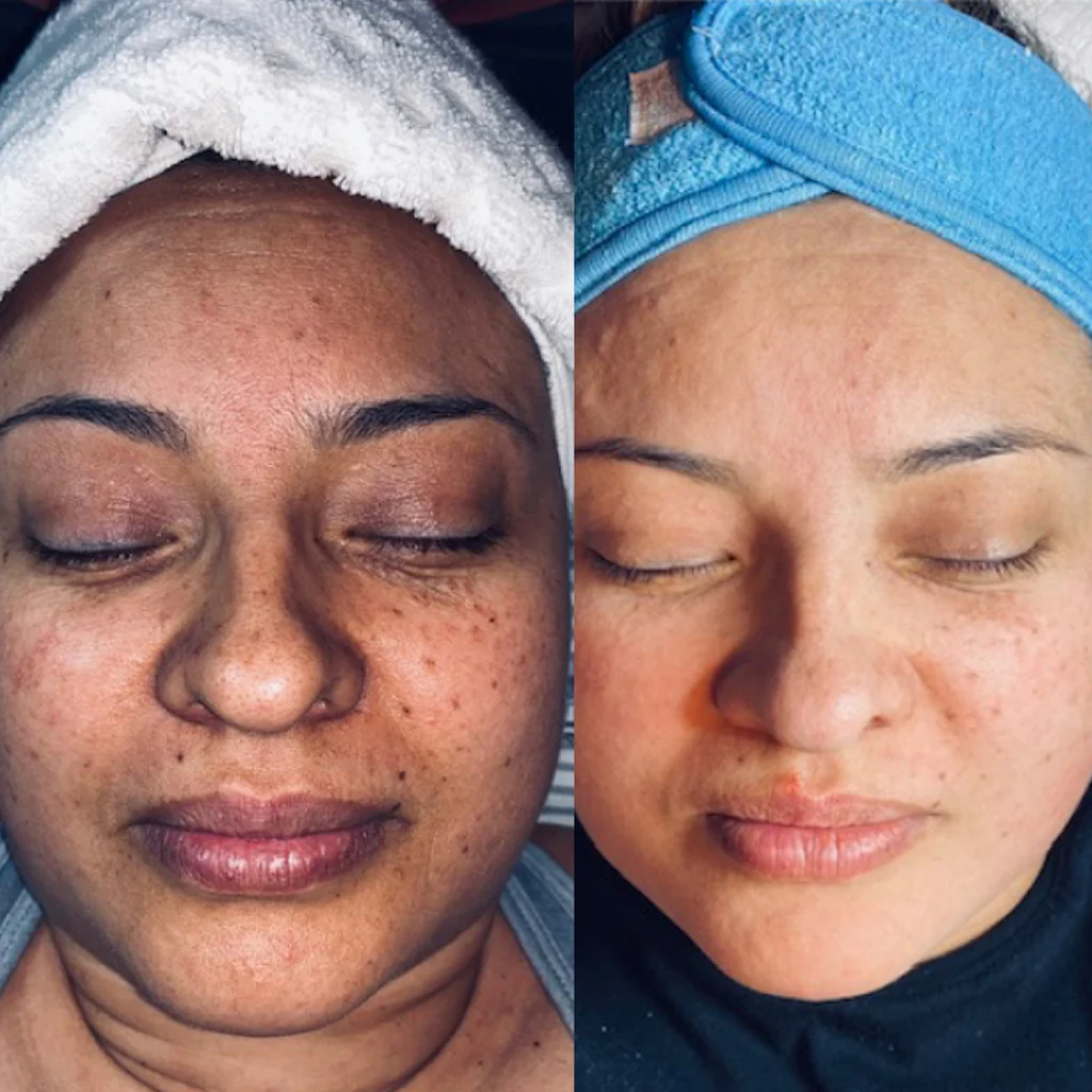 Glycolic Gel Peel